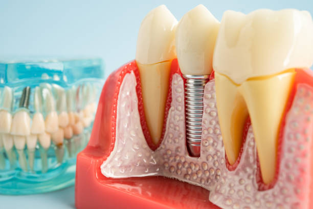 Best Dental Fillings (Composite and Amalgam)  in Riverbend, WA